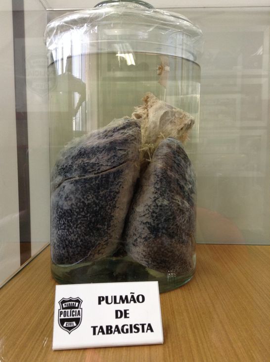 Foto de um pulmão de tabagista