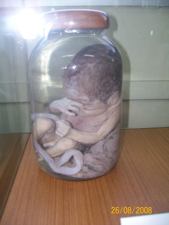 Foto de um feto