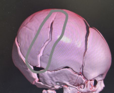 PCPR investiga lesão corporal grave contra lactente em Santa Tereza do Oeste