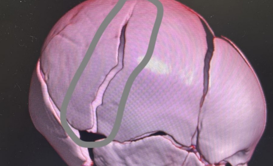 PCPR investiga lesão corporal grave contra lactente em Santa Tereza do Oeste